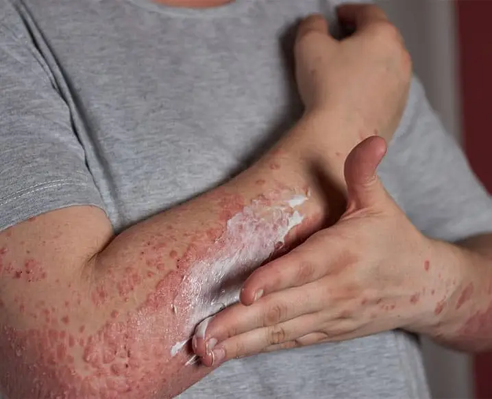 eczema treatment in Indore: healing the affected skin and preventing its symptoms from a flare-up.